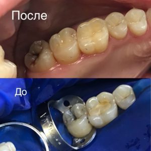 Как выглядят зуб после лечения кариеса