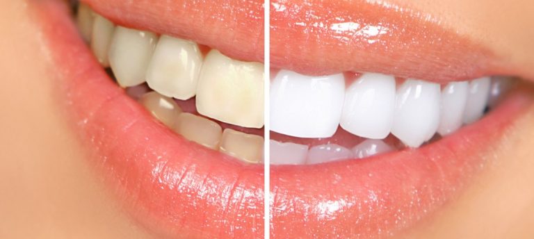 Пример отбеливания зубов