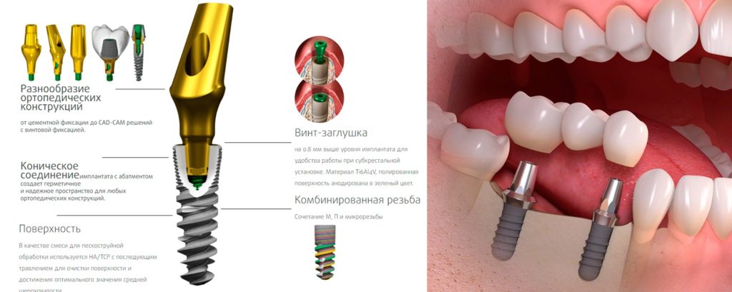 Установка имплантов зуба
