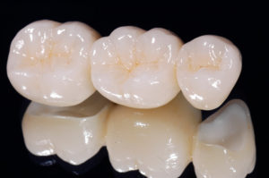 Циркониевая коронка на зуб