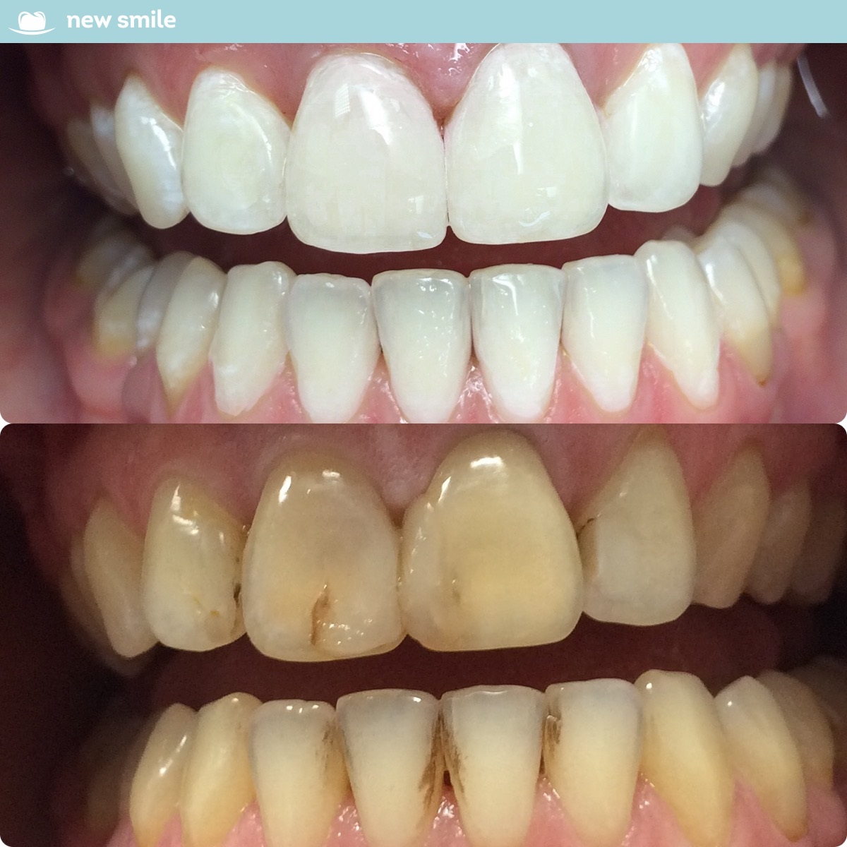 Отбеливание зубов opalescence или zoom противопоказания к использованию ирригатора