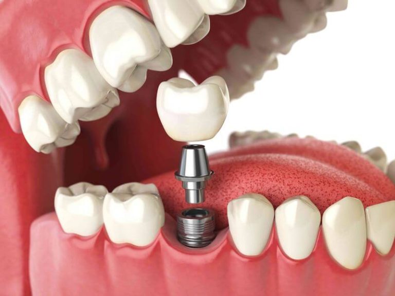 Протезирование зубов на имплантах