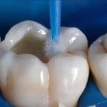 Реставрация и восстановление зубов