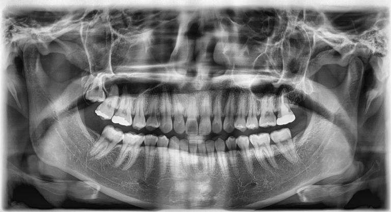 Панорамный снимок зубов и рентген